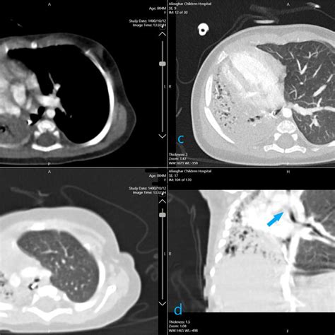 Iv Contrast Chest Ct Scan Shows A Hypoplastic Right Lung With