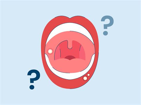 Can You Pop a Canker Sore?