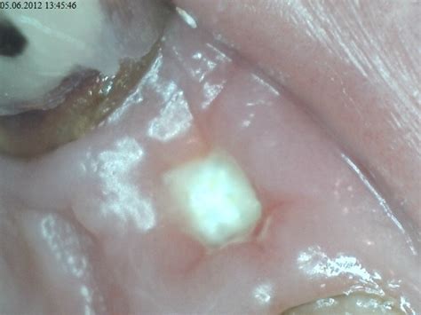 White Bump After Wisdom Teeth Removal Teethwalls