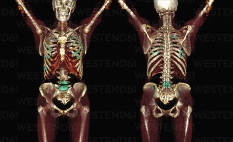 3d Ct Scan Of Metastatic Bone Cancer Stock Photo