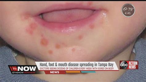 While hand, foot, and mouth isn't usually dangerous, in rare instances viral meningitis or encephalitis may occur with hfm. Hand, foot and mouth disease spreading in Tampa Bay area ...