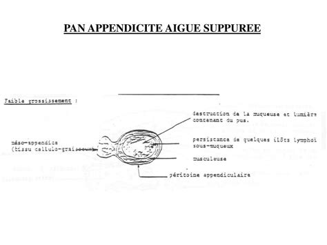 Voici une ou plusieurs définitions pour le mot parietale afin de vous éclairer pour résoudre vos mots fléchés et mots croisés. PPT - PAN APPENDICITE AIGUE SUPPUREE PowerPoint ...