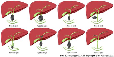 Biliary Atresia And Congenital Disorders Of The Extrahepatic Bile Ducts