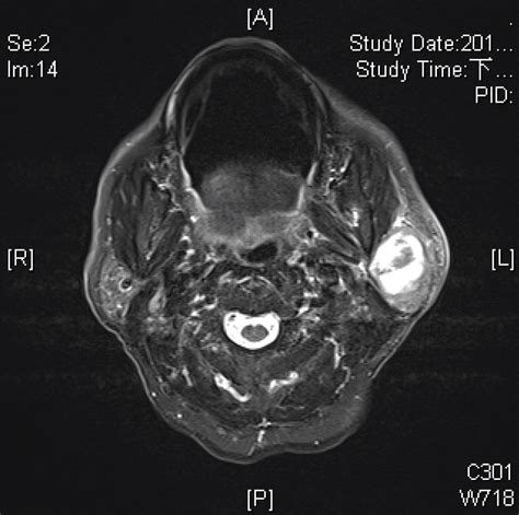 Full Text Mycobacterium Tuberculosis Infection Within A Parotid