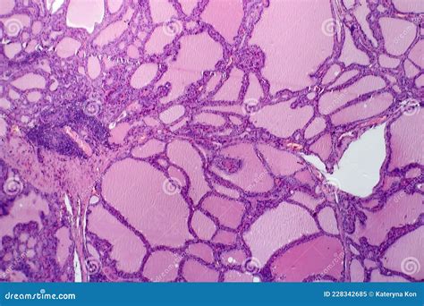 Histopathology Of Endemic Goitre Stock Image Image Of Detail Thyroid