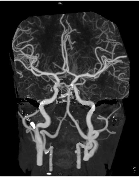 Carotid Artery Disease Neuro Case Studies Ctisus Ct Scanning