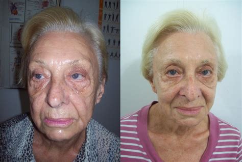 Acupuntura No Rosto Antes E Depois