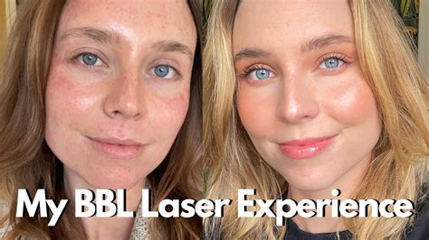 My Bbl Laser Experience What You Need To Know Broadband Light Photofacial Youtube