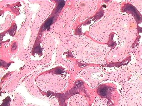 The Histology Of Fibrous Dysplasia Reveals Fibroblasts Collagen And