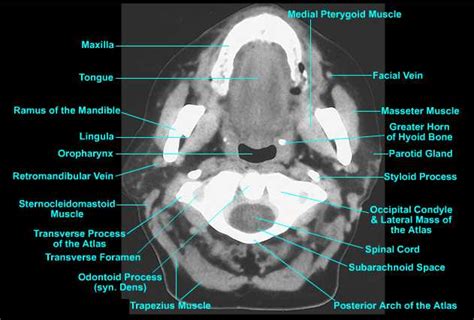 Ct Neck Anatomy Anatomical Charts And Posters