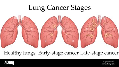 Stages Of Lung Cancer Diagram