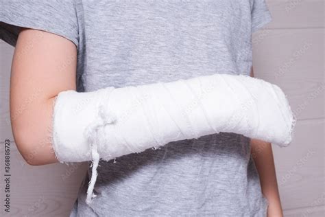 A Child Broken Arm In Plaster Case Hand Injury Because Of Accident