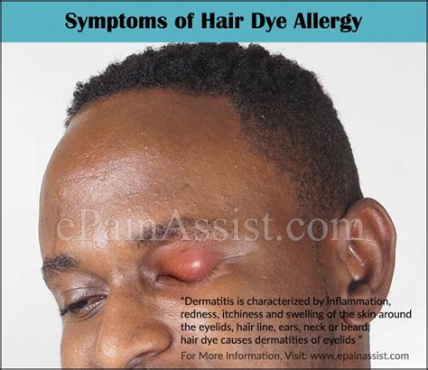 How Long Does Hair Dye Allergy Last And How To Avoid Getting Allergy To