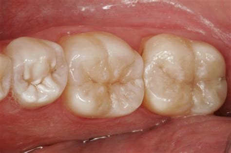 White Fillings In Lancashire Replacing Amalgam Fillings Private Dentist