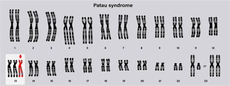 Patau Syndrome Causes Symptoms And Life Expectancy
