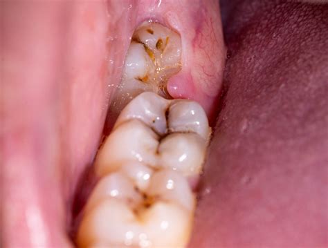 Impacted Wisdom Tooth Due Which Gum Hood Formed Inflammation Gums Stock