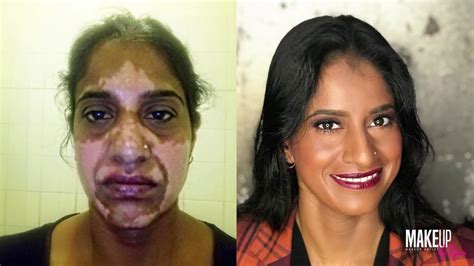 Vitiligo Before And After Makeup By Ryno Youtube