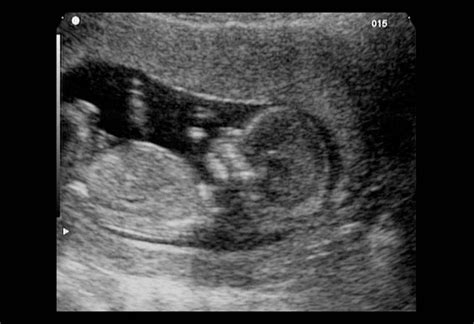 12 Weeks Pregnant Ultrasound Process Abnormalities And Accuracy
