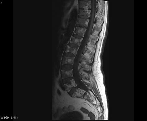 Common complications include recurrent bacterial infections, anemia, osteolytic lesions and renal insufficiency. Brain and Spines: Spinal multiple myeloma