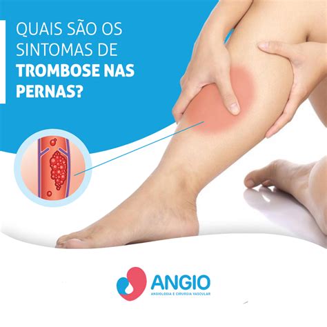 Qual O Sintoma Da Trombose