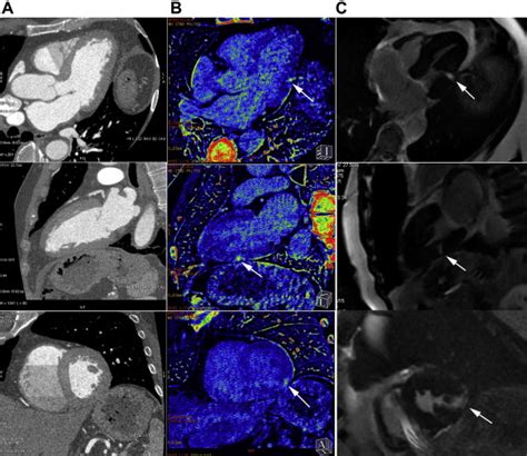 Spectral Contrast Enhanced Cardiac Computed Tomography For Diagnosis Of