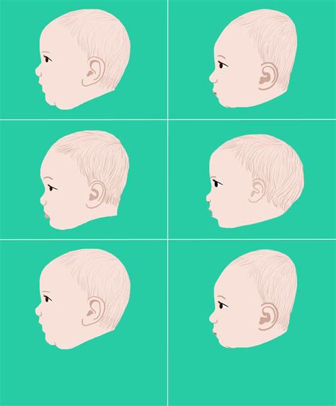 There Are Ways To Prevent Baby From Developing Flat Head Syndrome Find