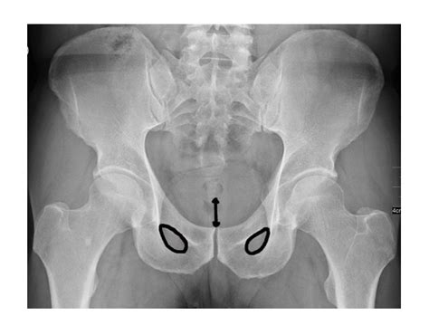 Extract lower portion of image. Back to Basics: Pelvic XRays — Taming the SRU