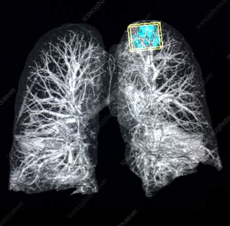 Right Upper Lobe Lung Mass X Ray Stock Image C0394275 Science