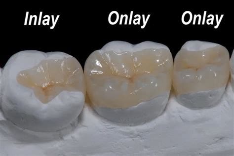 Crowns Inlays And Onlays Dr Dental Clinics