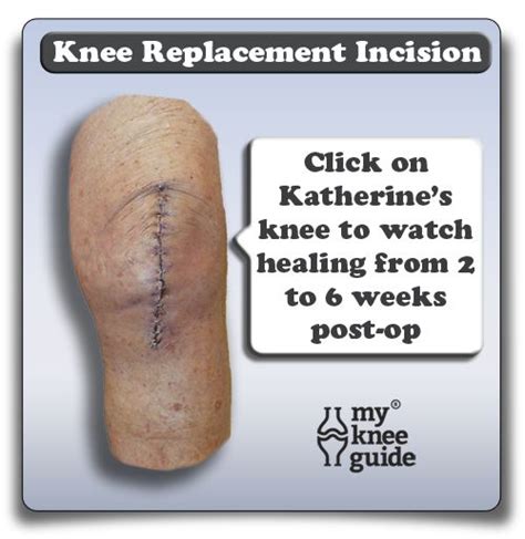 Knee Replacement Incision