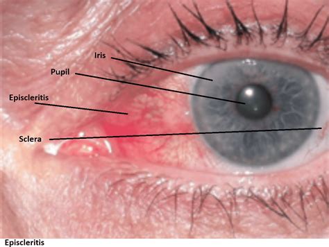 Cureus Reoccurring Episcleritis And The Role Of Antioxidants