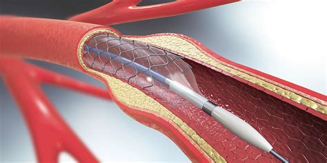 Blocked Arteries Skip The Stent And Surgery Researchers Say Premier