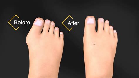 Before And After Bunion Surgery Recovery Youtube