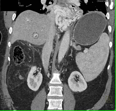 Large Esophageal And Gastric Varices Due To Portal Hypertension