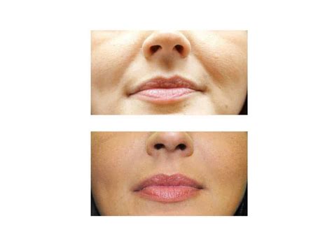 Smile Line Fillers Carlisle Look And Feel Your Very Best Vl Aesthetics