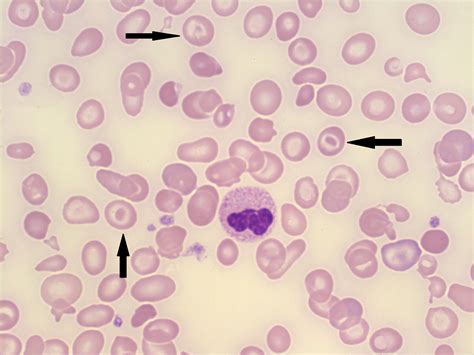 Myelofibrosis Teardrop Cells
