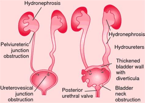 Hydronephrosis Definition What Is Symptoms Treatment Causes