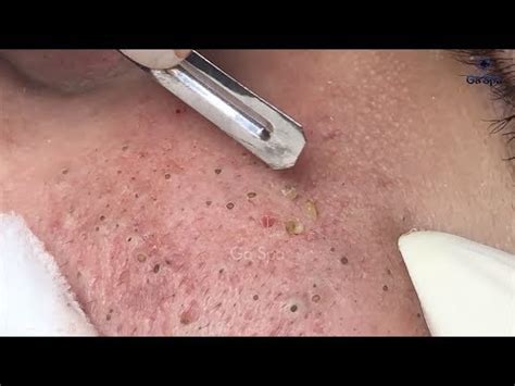 Aggie's video had over 42,000 views before removal, by far the most views of any video on her channel. Full Blackhead Popping Video - HOT 2019 - Part 2 ...