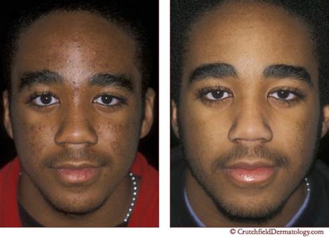 Acne Laser Treatment On Dark Skinned Teenager Before And After A Photo