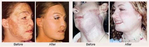 Severe Burn Victims Before And After