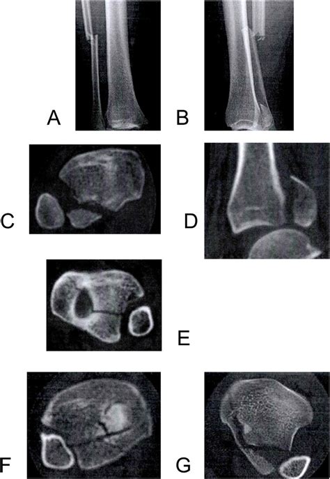 Ct Images Of Different Types Of Pilon Fracture A Type I Posterior