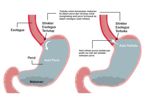 Apabila makan dalam jumlah banyak, perut akan terpaksa bekerja keras dalam jangka masa yang lebih pengambilan rokok dan alkohol apabila berbuka ini akan menyebabkan rasa pedih lu hati. Hilangkan Pedih Ulu Hati Yang Disebabkan Oleh Refluks Asid