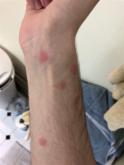 Are These Bed Bug Bites They Dont Itch Bedbugs