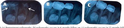 Pdf Comparison Of Clinical And Radiographic Success Between Mta And