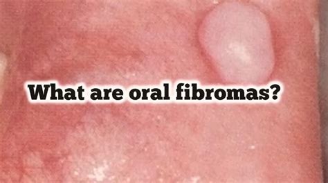 What If I Have Oral Fibroma Symptoms And Treatment Health Weighup