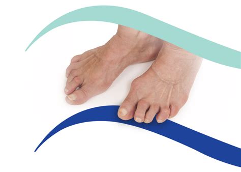 Arthritic Feet Treatments In Brighton And Hove Hove Foot Clinic