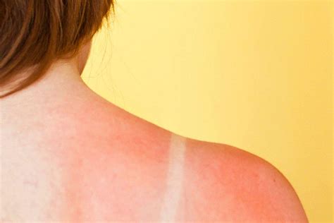 does sunburn turn into tan separating fact from fiction
