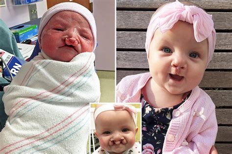 Adorable Baby Born Without A Top Lip Can Finally Smile