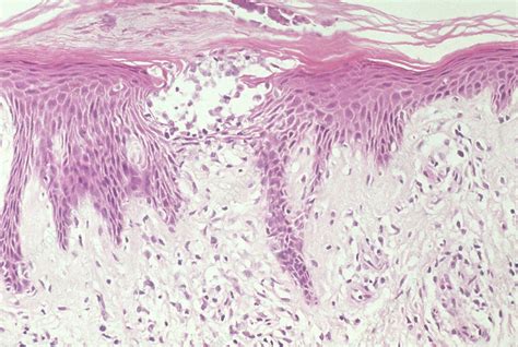 Spongiotic Dermatitis Histology