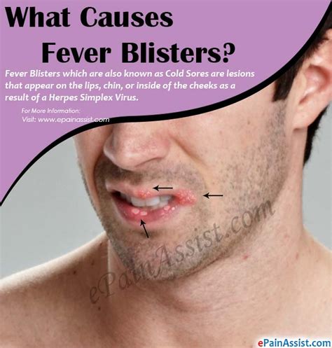What Causes Fever Blisters And What Are The Natural Remedies To Get Rid Of It